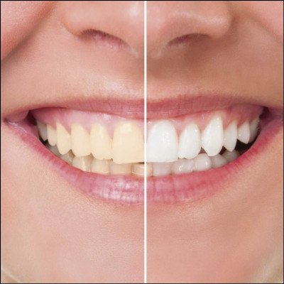 Clareamento Dental