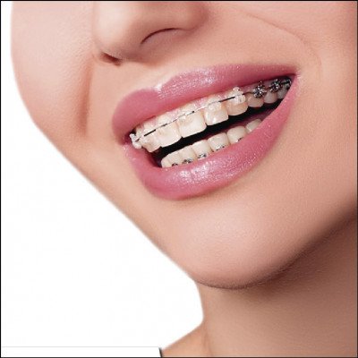 Aparelhos Dentários