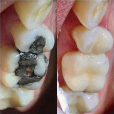 Restaurações Estéticas