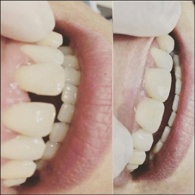 Fechamento Espaços com Resina Composta