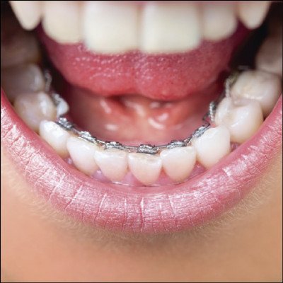 Aparelho Lingual