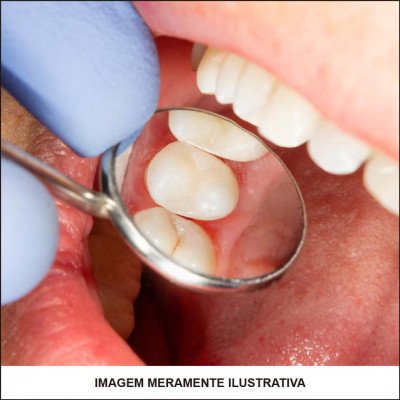 Restauração Nos Dentes