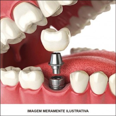 Implante Dentário