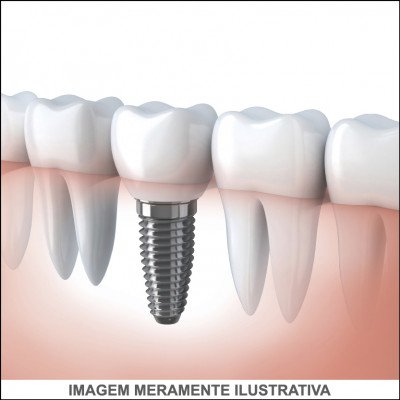 Implante Dentário