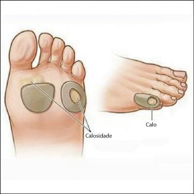 Calosidade