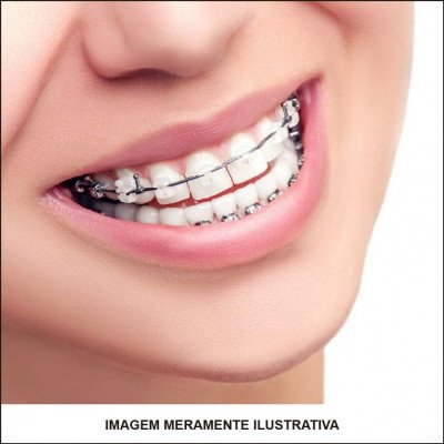 Aparelho Ortodôntico